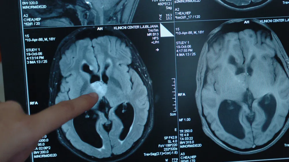 aparat za slikanje z magnetno resonanco magnetom trio (3T), - Klinični center Ljubljana (KC) - Klinični in&scaron;titut za radiologijo &ndash; tumor v možganih <br><br><br>,//FOTO: Matej Pov&scaron;eOPOMBA: ZA OBJAVO V ČASOPISU DNEVNIK