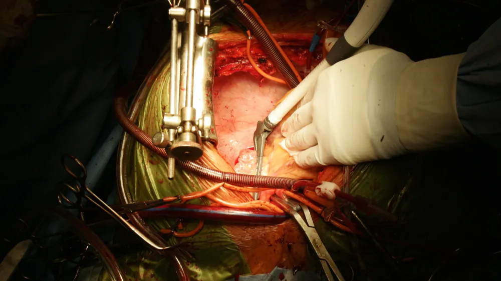 prof. dr. Borut Ger&scaron;ak, kardio kirurg in predstojnik oddelka za kirurgijo srca in ožilja- operacija srca, srcna zaklopka, zdravnik, bolnica, bolnik, pacient, srce, instrumentiFOTO: JAKA GASAR / NEDELJSKI