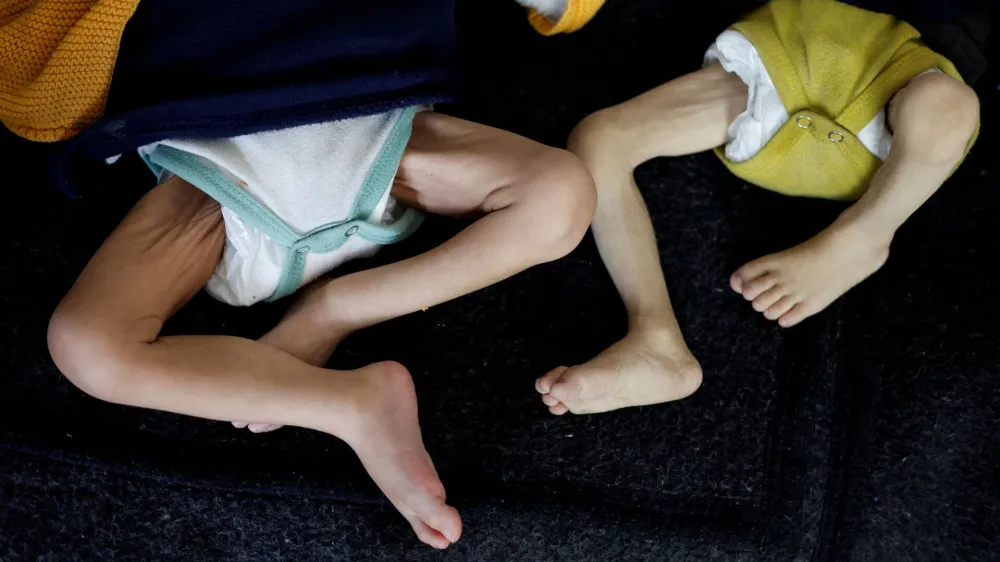 Palestinske otroke, ki trpijo zaradi podhranjenosti in vsesplo&scaron;ne lakote v Gazi, so odpeljali na zdravljenje v zdravstveni center v Rafi. Foto: Reuters