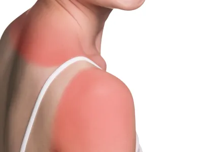 Sunburn female shoulder isolated on white background