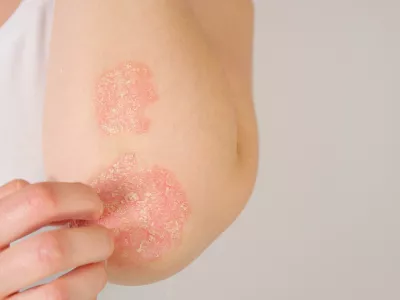 Na koži se lahko pojavijo tak&scaron;ni rdeči madeži. / Foto: Istock