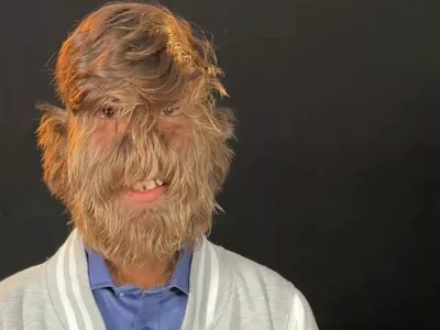 Ferrari Press Agency Hairy 1Ref 1660506/03/2025See Ferrari textPictures must credit: Guinness World RecordsA teenager with a condition that causes abnormal hair growth all over his body has gained a record &mdash; for having the hairiest male face in the world.Lalit Patidar, 19, from India, has hypertrichosis which causes excessive hair growth. The title was confirmed by the Guinness World Records.In order to assess him he visited Italy to take part in a television show andwhilst in the country he visited a local trichologist who assessed him.To take accurate measurements, tiny portions of Lalit's face were shaved to assess how many hairs per square cm he has.They discovered he has 201.72 hairs per square cm.A spokesperson said: "The results confirmed that Lalit indeed does have the hairiest face in the world."OPS: Lalit Patidar Picture supplied by Ferrari,Image: 972774911, License: Rights-managed, Restrictions:, Model Release: no