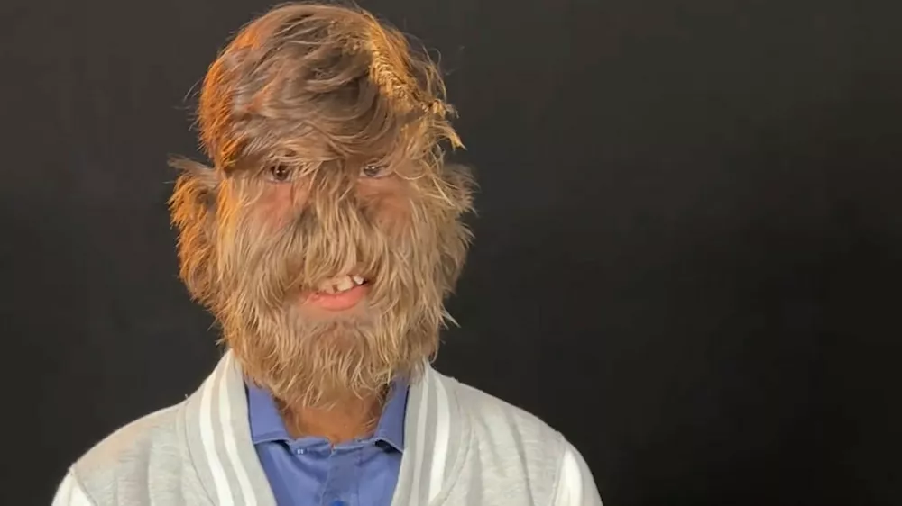 Ferrari Press Agency Hairy 1Ref 1660506/03/2025See Ferrari textPictures must credit: Guinness World RecordsA teenager with a condition that causes abnormal hair growth all over his body has gained a record &mdash; for having the hairiest male face in the world.Lalit Patidar, 19, from India, has hypertrichosis which causes excessive hair growth. The title was confirmed by the Guinness World Records.In order to assess him he visited Italy to take part in a television show andwhilst in the country he visited a local trichologist who assessed him.To take accurate measurements, tiny portions of Lalit's face were shaved to assess how many hairs per square cm he has.They discovered he has 201.72 hairs per square cm.A spokesperson said: "The results confirmed that Lalit indeed does have the hairiest face in the world."OPS: Lalit Patidar Picture supplied by Ferrari,Image: 972774911, License: Rights-managed, Restrictions:, Model Release: no