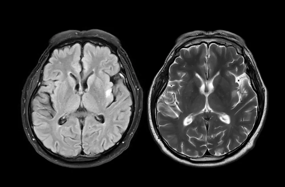 MRI brain scan axial T1W for detect Brain diseases sush as stroke disease, Brain tumors and Infections. / Foto: Mr.suphachai Praserdumrongchai