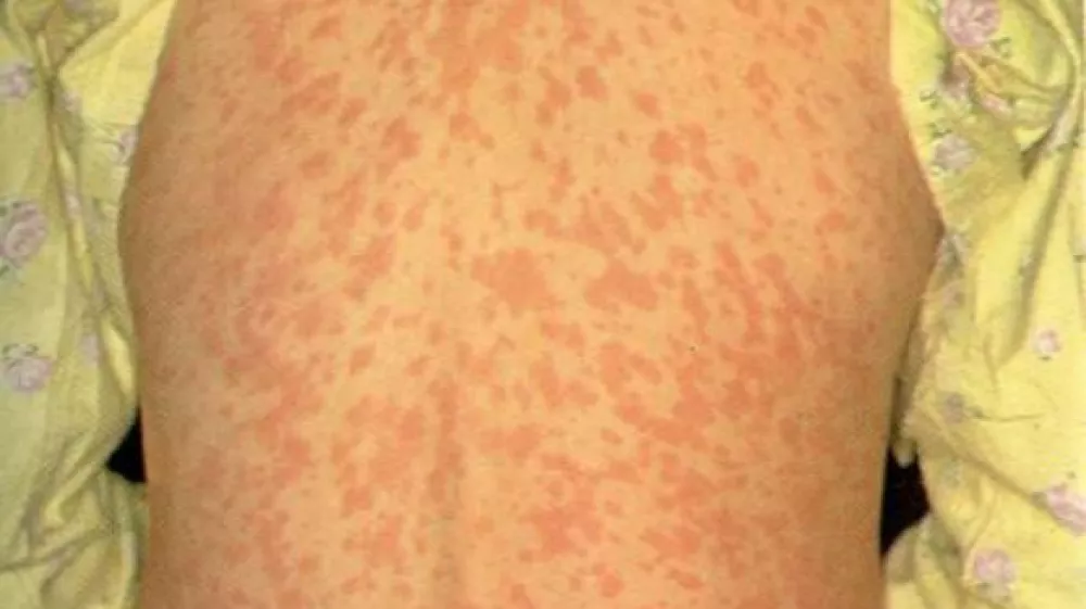 Nalezljiva bolezen o&scaron;pice