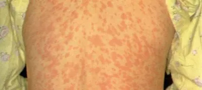 Nalezljiva bolezen ošpice