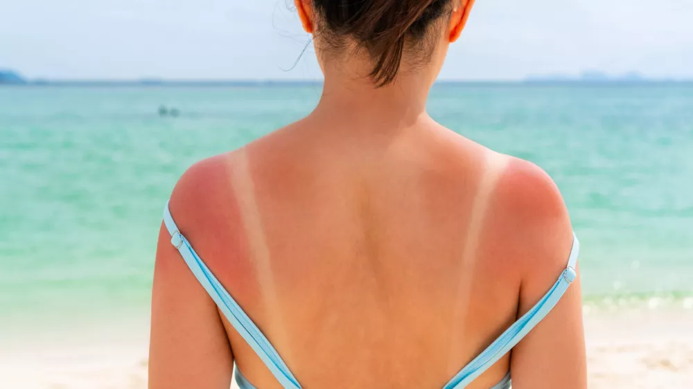 Posebej izpostavljena so ramena.