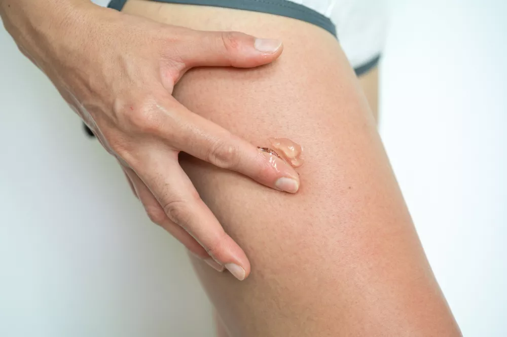 Pomagamo si lahko z gelom aloe vere.