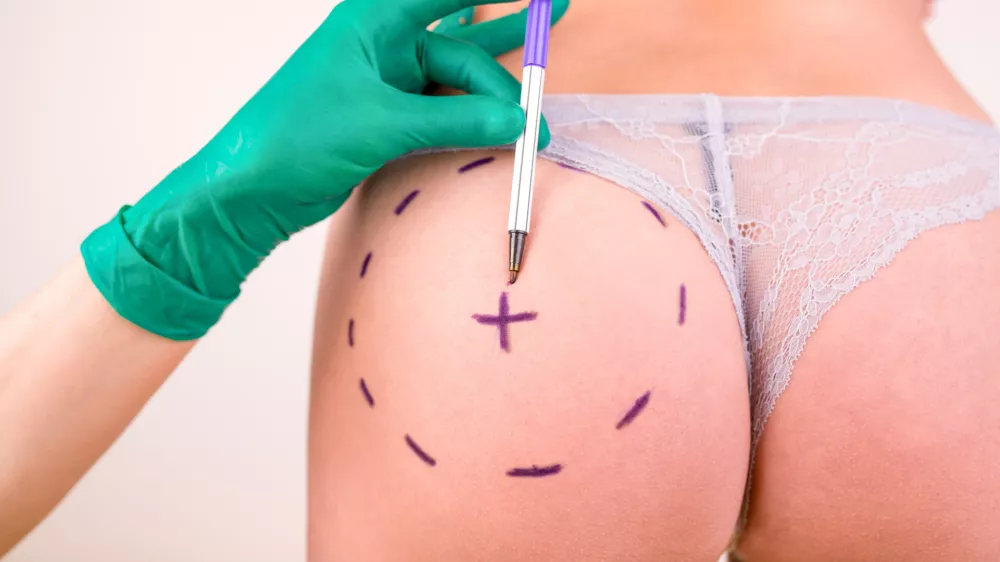 Surgeon drawing marks on female body before plastic operation, white background. Liposuction concept / Foto: Georgiy Datsenko