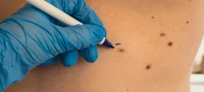 Doctor in medical gloves paint lines around male birthmarks. Preparing procedure for medical surgery. Laser skin tags removal. Prevention of melanoma and nevus exam / Foto: Anastasiia Yanishevska