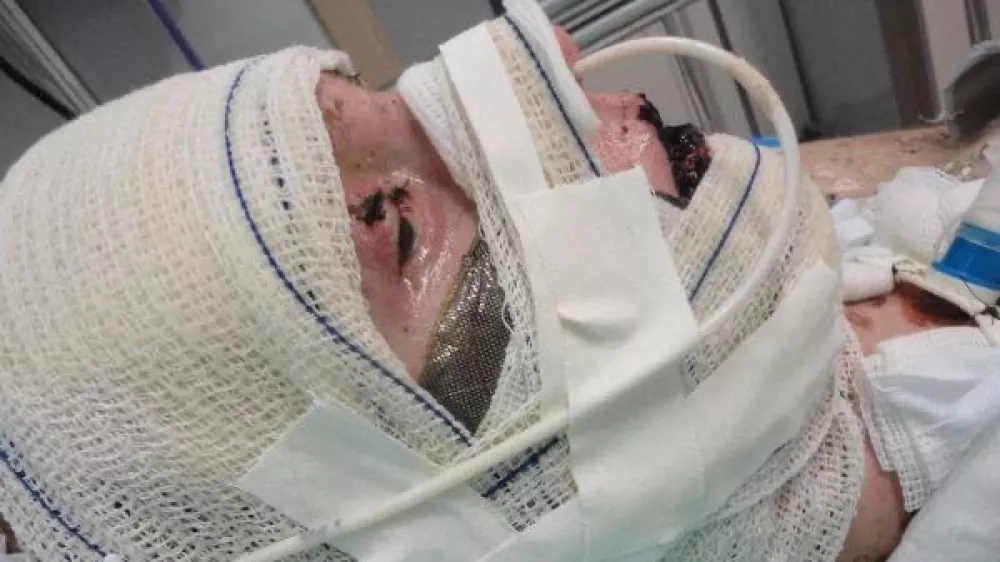 EXCLUSIVE: Story from Jam Press (Steven Johnson Syndrome) Woman left 'burning from inside out' after taking Ibuprofen devastated as doctors say vision is lost for goodA woman who was left 'burning from the inside out' and in a 17-day coma from an extreme reaction to Ibuprofen will never get her sight back, doctors have confirmed.Jaqueline Gmack took the over-the-counter medication to alleviate menstrual cramps, but soon started to experience terrifying symptoms, including blistering skin.The 32-year-old was taken to hospital and put into an induced coma, with doctors discovering her body's reaction to the medication had triggered a rare condition called Stevens-Johnson syndrome (SJS).It was a "miracle" she survived the traumatising incident, but despite 26 operations to save her vision, doctors have recently confirmed the vision in her right eye is lost for good, and vision in her left eye is extremely limited."It has taken a while for the reality to sink in &ndash; I entered a period of real mourning," Jaqueline, from Papanduva, Brazil, told NeedToKnow."I don't recognise faces on the street, I can barely see who's next to me."I can't walk alone because I can't see steps, holes, or obstacles."Jaqueline has been suffering corneal perforation &ndash; where the cornea, in the front part of the eye, has a hole or opening &ndash; since the incident, and has recently had two corneal transplants to prevent her eye from leaking.The issue means she can't regain clear vision, but the first transplant wasn't fully successful, leading to a second in February which involved having her eyelids sewn shut.She said: "I was devastated and overwhelmed because I didn't want my eyelids to be sewn, but I knew it was the only option to save my eye from further corneal damage."A few months on, the stitches eventually fell out, but doctors delivered the devastating news that she will no longer be able to see out of her right eye due to the extensive damage caused by.26 Aug 2025Pictured: WARNING, CONTAINS GRAPHIC CONTENTStory from Jam Press (Steven Johnson Syndrome) Pictured: Jaqueline Gmack in hospital.Woman left 'burning from inside out' after taking Ibuprofen devastated as doctors say vision is lost for goodA woman who was left 'burning from the inside out' and in a 17-day coma from an extreme reaction to Ibuprofen will never get her sight back, doctors have confirmed.Jaqueline Gmack took the over-the-counter medication to alleviate menstrual cramps, but soon started to experience terrifying symptoms, including blistering skin.The 32-year-old was taken to hospital and put into an induced coma, with doctors discovering her body's reaction to the medication had triggered a rare condition called Stevens-Johnson syndrome (SJS).It was a "miracle" she survived the traumatising incident, but despite 26 operations to save her vision, doctors have recently confirmed the vision in her right eye is lost for good, and vision in her left eye is extremely limited.,Image: 1031420443, License: Rights-managed, Restrictions: NO Australia, Germany, Norway, South Korea, Sweden, United Kingdom, United States, Unknown Country, Model Release: no, Pictured: Jaqueline Gmack