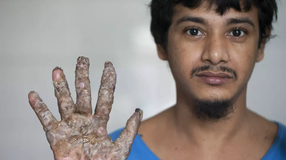 DHAKA, BANGLADESH - 2016/08/09: Abul Vajondar was identified with epidermodysplasia verruciformis a rare skin disease. After surgery he is better now and under treatment at the Dhaka Medical College Hospital. Abul Vajondar has been suffering bark-like warts on his hands and feet since four years. (Photo by K M Asad/LightRocket via Getty Images) / Foto: K M Asad