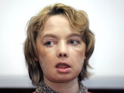 Isabelle Dinoire, the woman who received the world's first partial face transplant with a new nose, chin and mouth, in an operation on Nov. 27, 2005, addresses reporters during her first press conference since the transplant at the Amiens hospital, northern France Monday Feb. 6, 2006. The 38-year-old woman was mauled by a dog in May, leaving her with severe facial injuries that her doctors said made it difficult for her to speak and eat. (AP Photo/Michel Spingler)