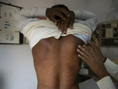 Primer gobavosti pri 25 let starem Indijcu. Na Hrva&scaron;kem so bolezen odkrili pri Nepalcu.