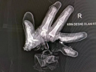 Po&scaron;kodbe pri nesrečah s pirotehniko so lahko zelo hude, po&scaron;kodovani pa lahko posledice nosi do konca življenja. 