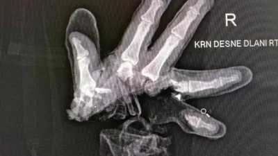 Poškodbe pri nesrečah s pirotehniko so lahko zelo hude, poškodovani pa lahko posledice nosi do konca življenja. 