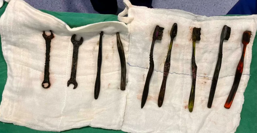 EXCLUSIVE: Story from Jam Press (Toothbrushes In Stomach)Pictured: A video grab of the doctors removing the seven toothbrushes and two spanners from inside the 26-year-old man's stomach.VIDEO: Tummy ache-suffering man leaves docs stunned as they find seven toothbrushes and two spanners in his stomachA tummy-ache-suffering man left doctors stunned after they found seven toothbrushes and two spanners in his stomach.They had been there for weeks.The 26-year-old was admitted to the hospital after complaining of chronic abdominal pain.Doctors were stunned to find multiple foreign objects inside his stomach.An endoscopy was attempted but failed to remove the objects.A senior gastroenterologist and his team then decided to proceed with open surgery.The operation lasted more than two hours in Jaipur, Rajasthan, India, as reported by What's The Jam.According to the doctors, the man's stomach was like a dustbin, and the objects could have been life-threatening.The patient from Bhilwara district was said to have a habit of swallowing iron tools and toothbrushes.He had swallowed these objects a month ago.But after the operation, his condition was described as stable.ENDSEDITOR'S NOTE: Video Usage Licence: (PROFESSIONAL PARTNER) We have obtained this material from a professional partner for use by our news media clients (company press release / other media agency).Video Restrictions: None.30 Dec 2025Pictured: Story from Jam Press (Toothbrushes In Stomach)Pictured: The seven toothbrushes and two spanners found inside the 26-year-old man's stomach.VIDEO: Tummy ache-suffering man leaves docs stunned as they find seven toothbrushes and two spanners in his stomachA tummy-ache-suffering man left doctors stunned after they found seven toothbrushes and two spanners in his stomach.They had been there for weeks.The 26-year-old was admitted to the hospital after complaining of chronic abdominal pain.Doctors were stunned to find multiple foreign objects inside his stomach.An endoscopy was attempted but failed to remove the objects.A senior gastroenterologist and his team then decided to proceed with open surgery.The operation lasted more than two hours in Jaipur, Rajasthan, India, as reported by What's The Jam.According to the doctors, the man's stomach was like a dustbin, and the objects could have been life-threatening.The patient from Bhilwara district was said to have a habit.,Image: 1062304669, License: Rights-managed, Restrictions: NO Australia, Germany, Norway, South Korea, Sweden, United Kingdom, United States, Unknown Country, Model Release: no