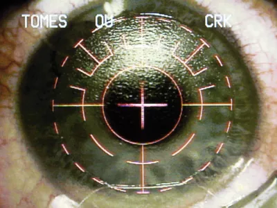 A television monitor shows the image from the operating microscope as Dr. Colman Kraff aligns the center of the pupil and the excimer laser for custom shaping of patient Christopher Tomes' eye during Lasik eye surgery at Kraff's offices in Chicago Nov. 1, 2005. (AP Photo/Charles Rex Arbogast)