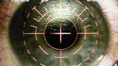 A television monitor shows the image from the operating microscope as Dr. Colman Kraff aligns the center of the pupil and the excimer laser for custom shaping of patient Christopher Tomes' eye during Lasik eye surgery at Kraff's offices in Chicago Nov. 1, 2005. (AP Photo/Charles Rex Arbogast)