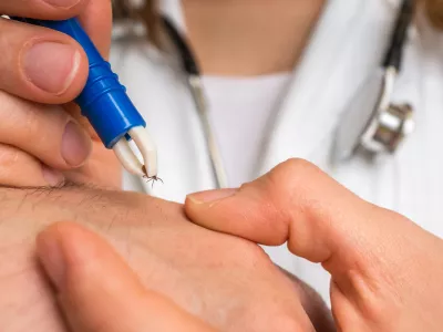 Female doctor removing a tick with tweezers from hand of patient. Encephalitis, borreliosis and lyme disease. / Foto: Andriano_cz Getty Images