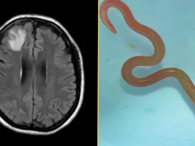 Slika možganov in vsiljivca. / Foto: Cdc