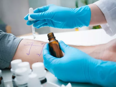 Skin prick allergy to find out kind of allergy / Foto: Alexraths Getty Images