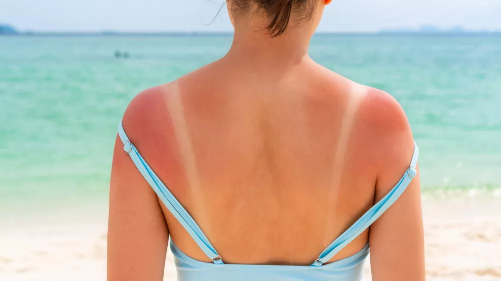 Posebej izpostavljena so ramena. / Foto: iStock