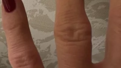 Otekla roka Kolinde Grabar-Kitarović. F instargram Kolinde Grabar-Kitarović